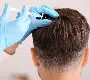 Avant la greffe de cheveux